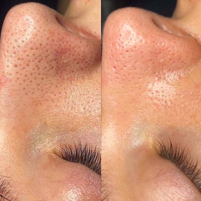 hydrafacial