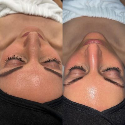 hydrafacial