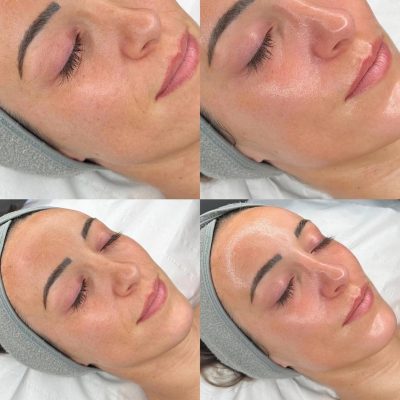 hydrafacial