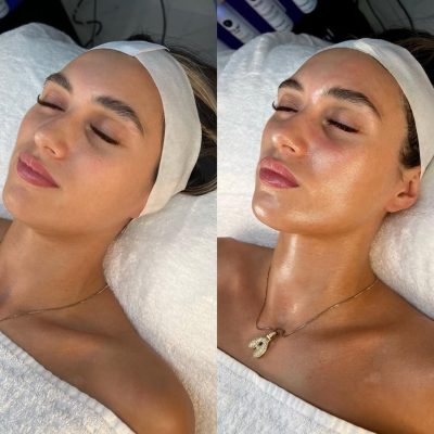 hydrafacial