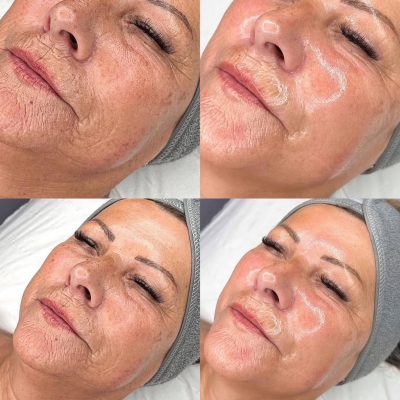 hydrafacial