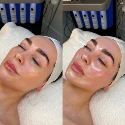 hydrafacial
