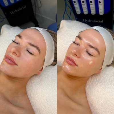 hydrafacial